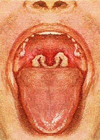 Difterite interno gola